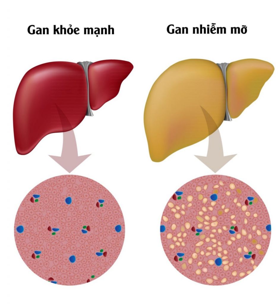gan-nhiem-mo